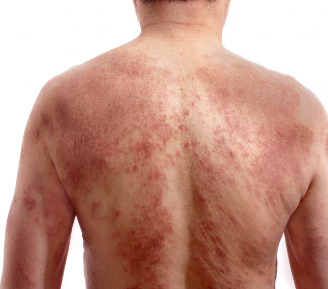 Eczema-back