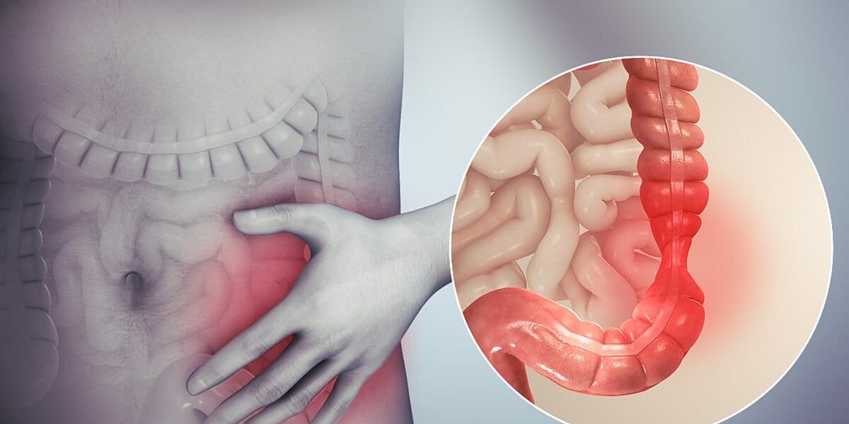 1200px-Irritable_bowel_syndrome IBS