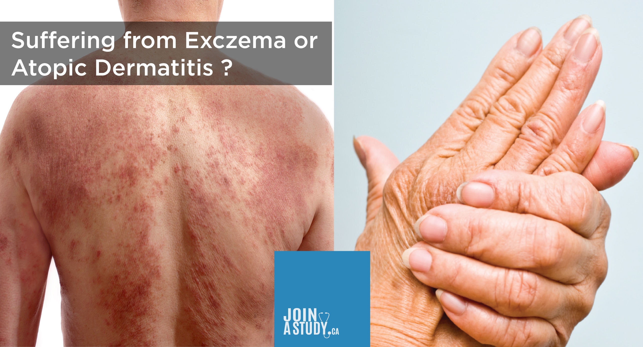 Atopic Dermatitis
