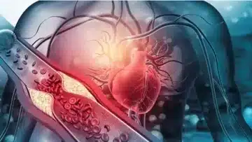hyperlipidemia