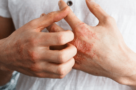 Psoriatic Arthritis Symptoms Causes + Self-Management, psoriasis