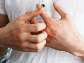 Psoriatic Arthritis Symptoms Causes + Self-Management, psoriasis