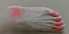 Risks, Symptoms, Treatments,& Foods to Avoid for Gout Risks, Symptoms, Treatments,& Foods to Avoid for Gout