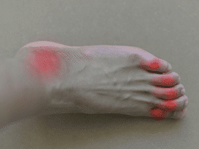 Risks, Symptoms, Treatments,& Foods to Avoid for Gout