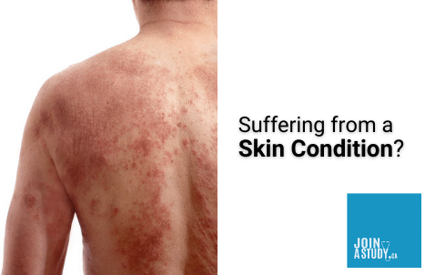 Skin Conditions