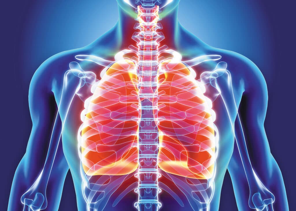 Acute Bronchitis