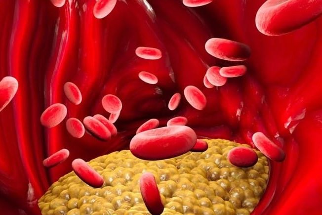 lipoprotein cholesterol, ascvd