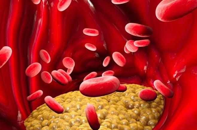 lipoprotein cholesterol, ascvd